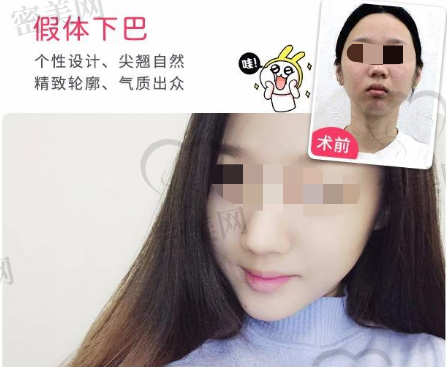 上海百达丽王玲假体垫下巴技术怎么样？有什么优势？