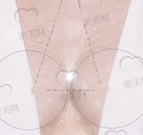 隆胸