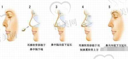 耳软骨隆鼻会产生位移吗？