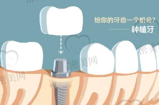 牙齿种植动漫21.jpg?x-oss-process=style/cnzxzj