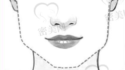 下颌角h03.jpg?x-oss-process=style/cnzxzj