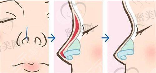新星靓定制整形医院隆鼻怎么样？