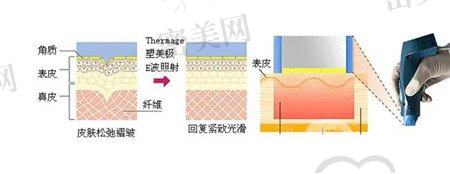 南方医院整形科做热玛吉贵不