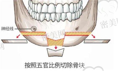 广州美恩医学美容医院颧骨内推