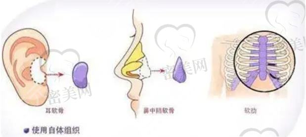 自体软骨隆鼻有哪些优缺点