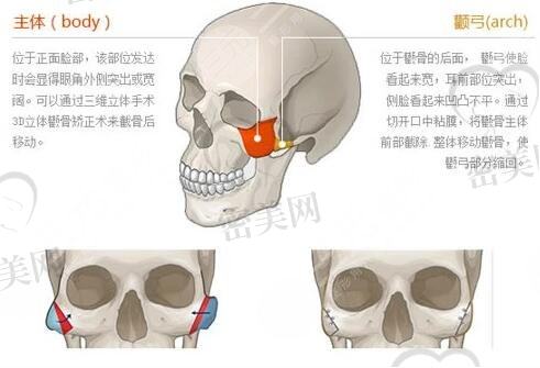 磨颧骨手术有什么风险和后遗症