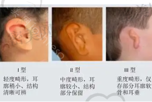宝宝6种常见畸形耳朵图片分享，畸形耳朵怎么矫正?