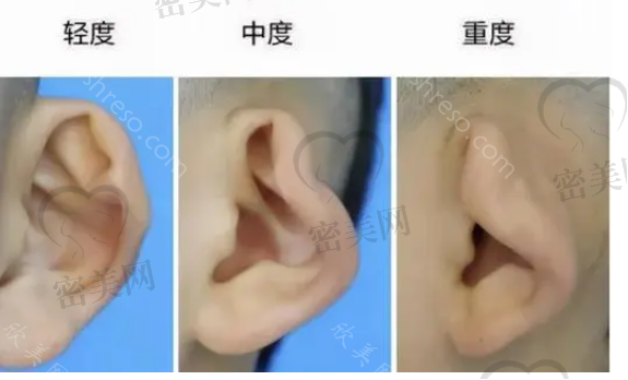 宝宝6种常见畸形耳朵图片分享，畸形耳朵怎么矫正?