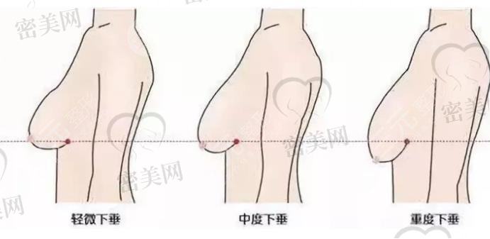 隆胸