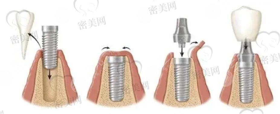 牙齿种植