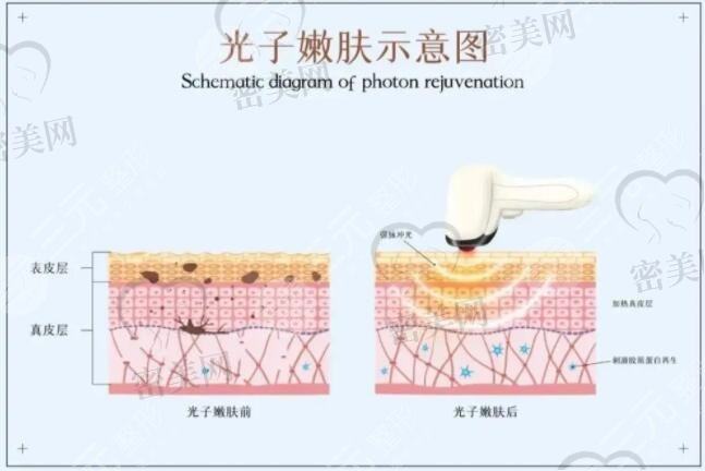 光子嫩肤