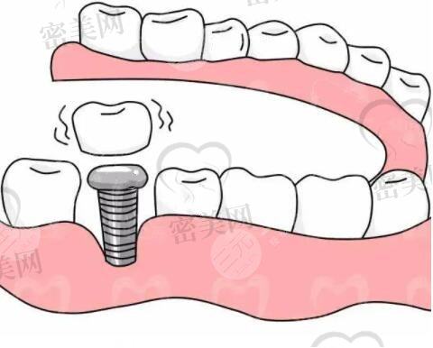 种植牙