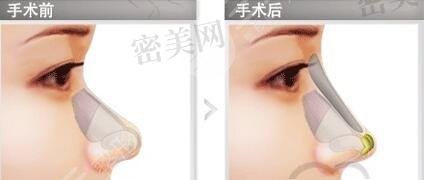 假体隆鼻手术