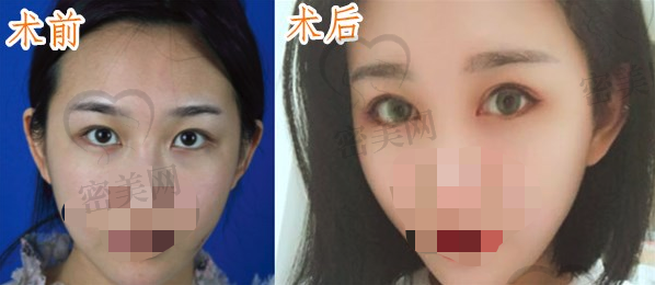 双眼皮手术前后效果对比