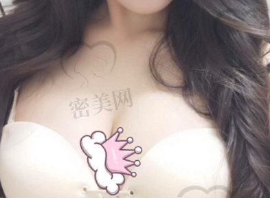 上海美莱汪灏院长隆胸一个月后照片