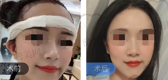 北京新面孔发际线种植前后效果对比案例