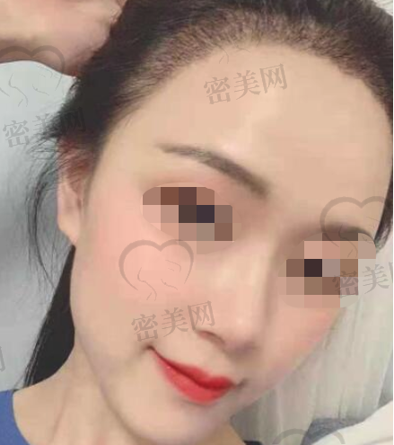 北京新面孔种植发际线后一个月