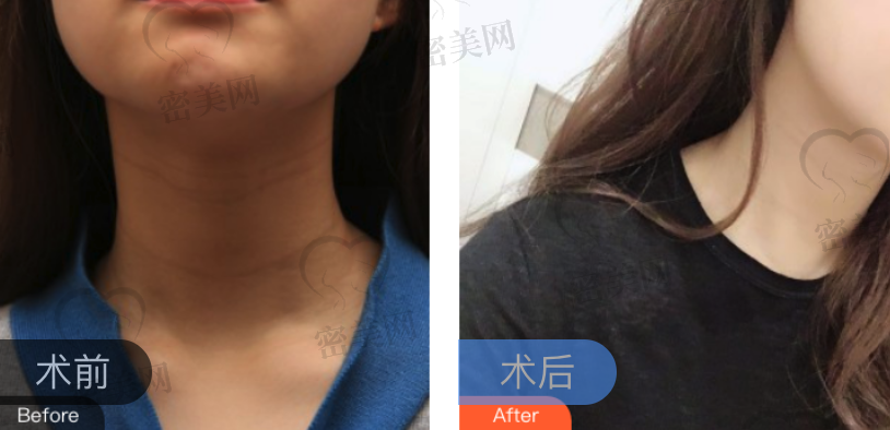 重庆光博士祛颈纹术前术后效果对比图