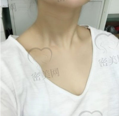 重庆光博士祛颈纹术后一个月照片