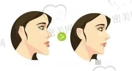 地包天图解