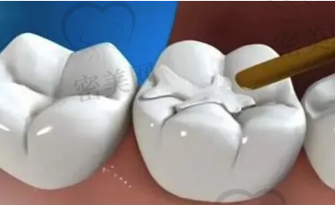 补牙之后就能完全恢复吗？如何判断牙釉质是否受损呢？