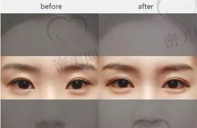 韩国原辰双眼皮线条不对称修复案例