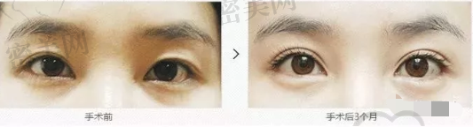 韩国原辰眼角修复+双眼皮案例