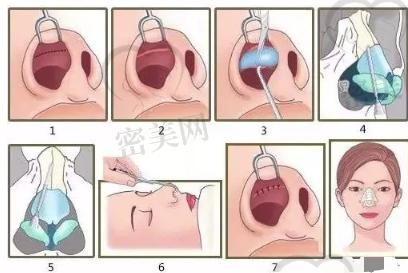 鼻整形流程