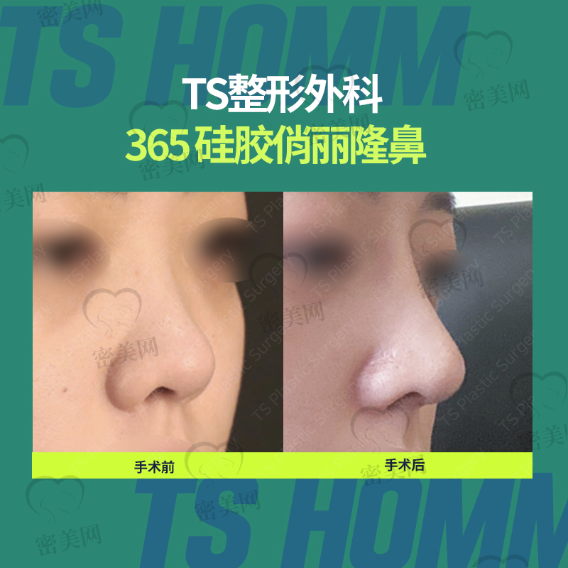 韩国TS整形外科医院---硅胶俏丽隆鼻！