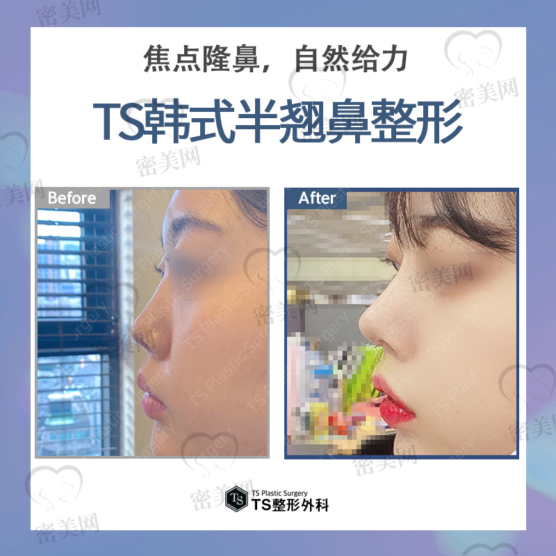 韩国TS整形外科医院---半翘鼻整形！
