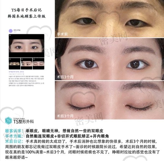 韩国TS整形本土顾客手术日记--自然黏连双眼皮！