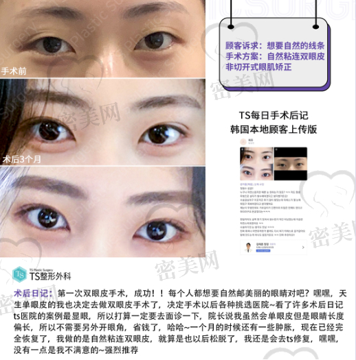 韩国TS本土顾客每日手术后记-自然粘连双眼皮+非切开眼肌矫正！