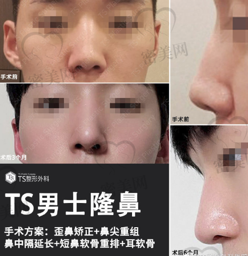 韩国TS整形外科医院男士隆鼻