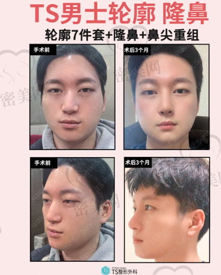 韩国TS男士面部轮廓7件套+隆鼻+鼻尖重组手术！