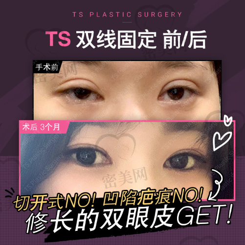 韩国TS整形外科香肠眼/肉条眼修复！