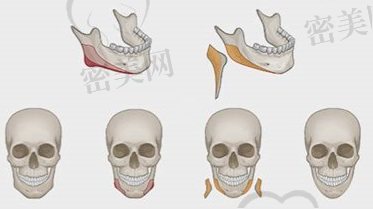 下颌角长曲线截骨