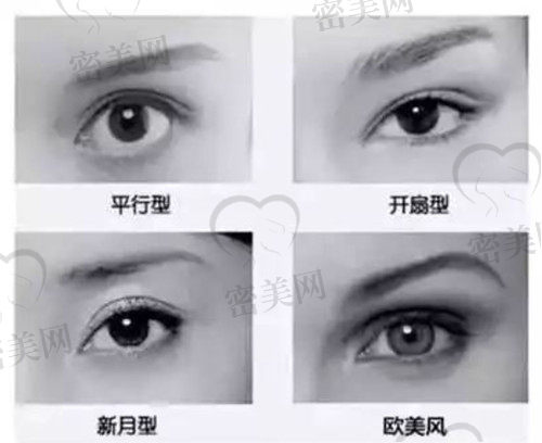 双眼皮的四种类型