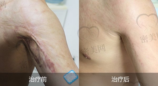 上海健桥疤痕医院疤痕治疗效果