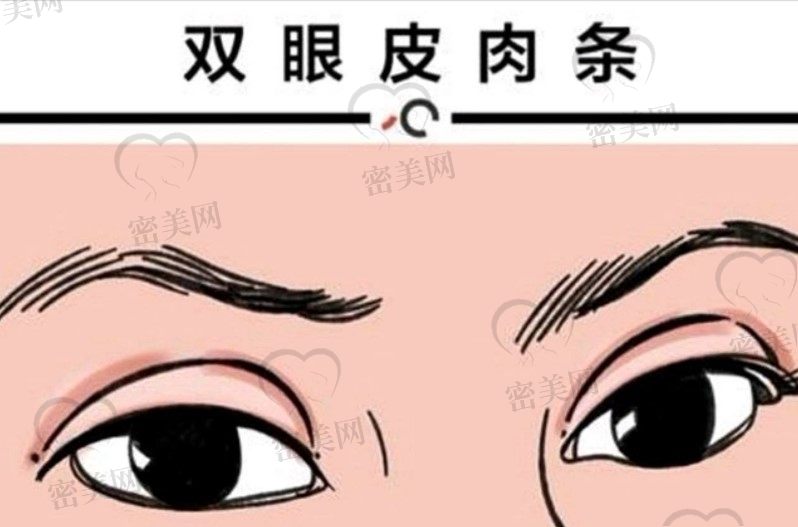 上海双眼皮修复厉害的医生