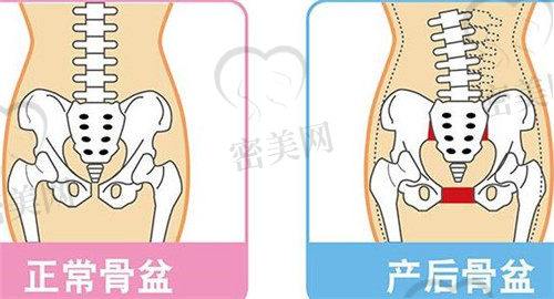 产后骨盆异常