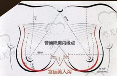 杭州艺星隆胸优势