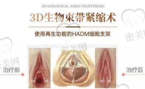 3D阴道紧缩术