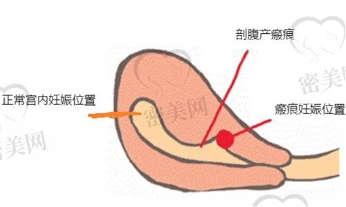 剖腹产子宫瘢痕会增厚吗