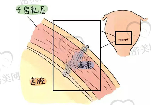 剖腹产子宫瘢痕会出现这种增厚吗