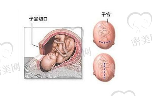 剖腹产后二胎要顺产需要注意什么呢