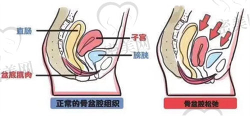 腹直肌分离怎么办？