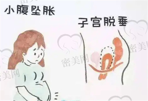 子宫脱垂表现