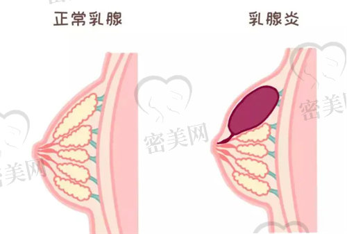 月子出现乳腺炎要怎么办