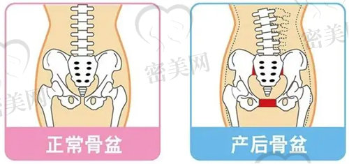 骨盆修复