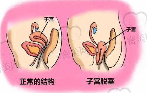 不晓得要是生完娃娃之后走的多会不会出现子宫下垂问题